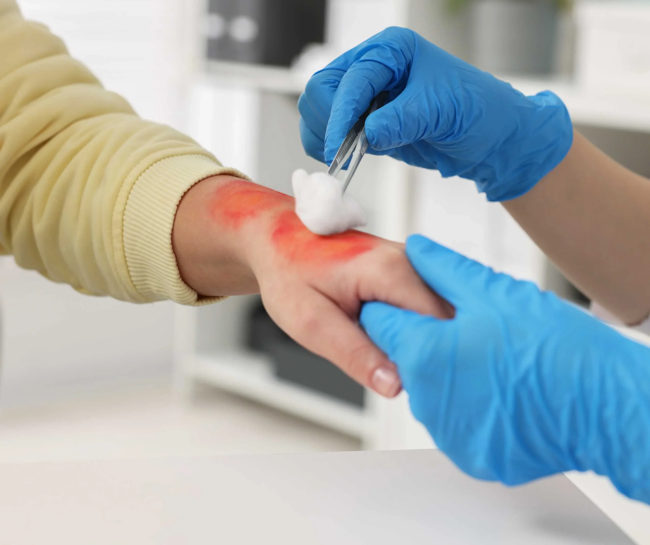 Burn Treatment