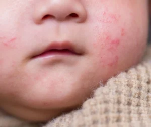 Children Rashes