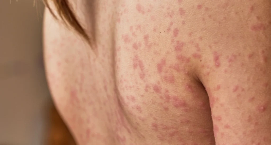 Rash Treatment