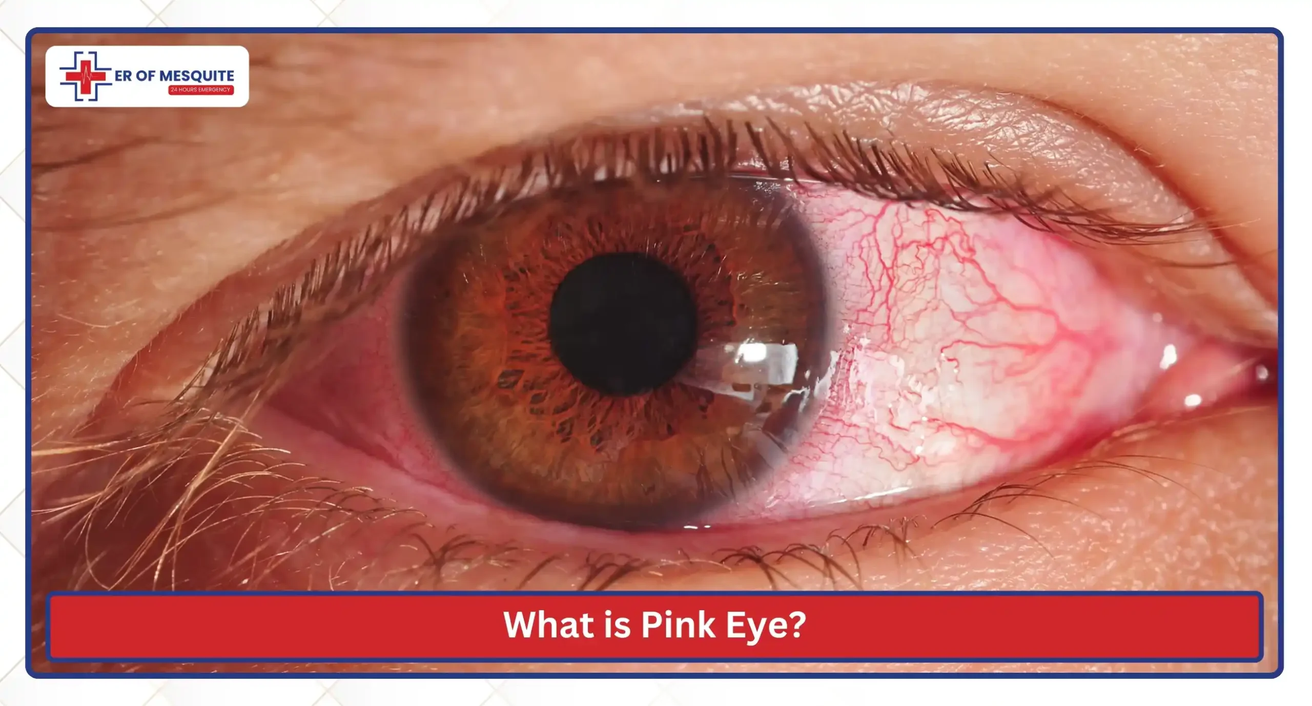 What is Pink Eye