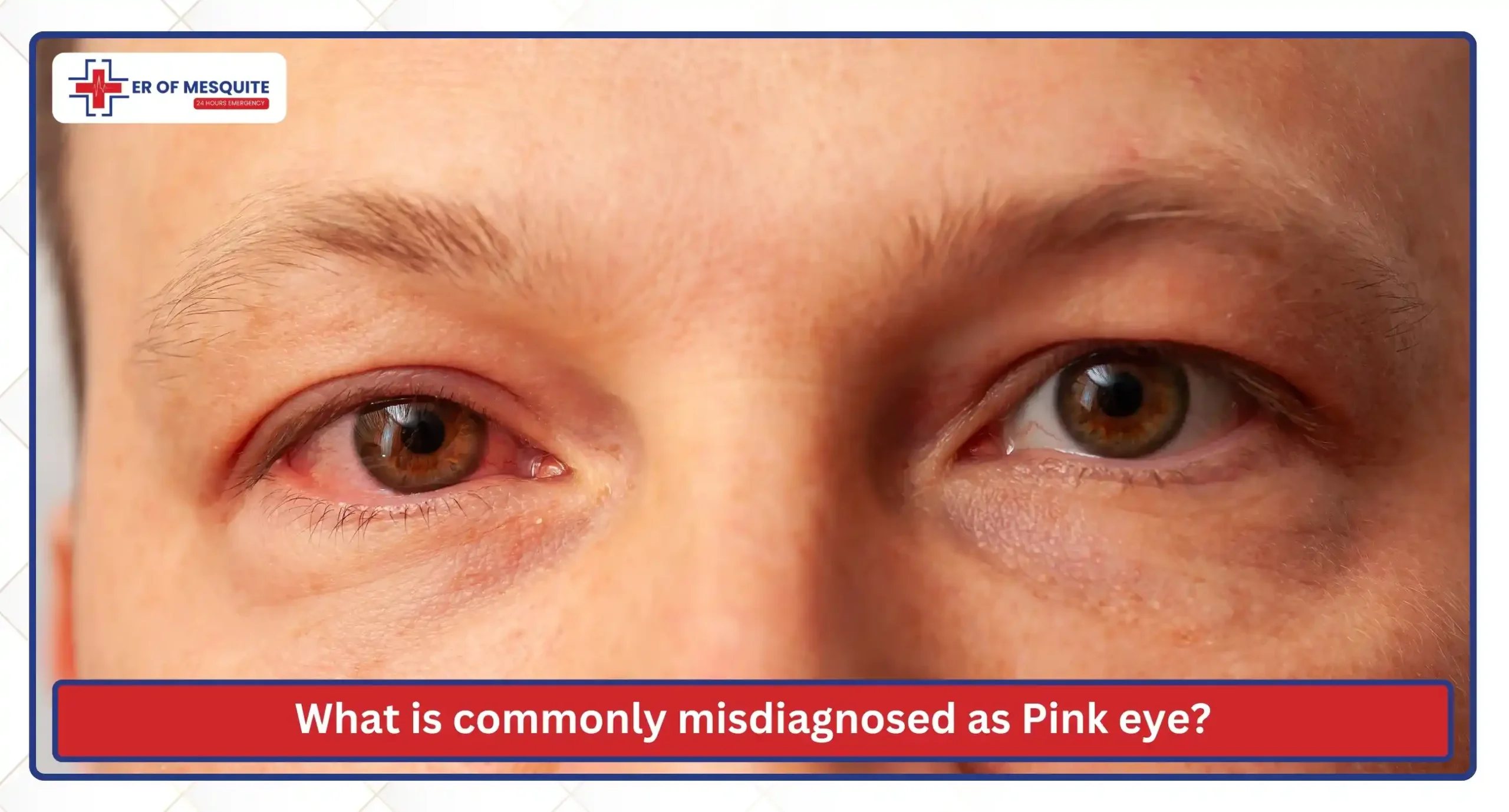 What is commonly misdiagnosed as Pink eye