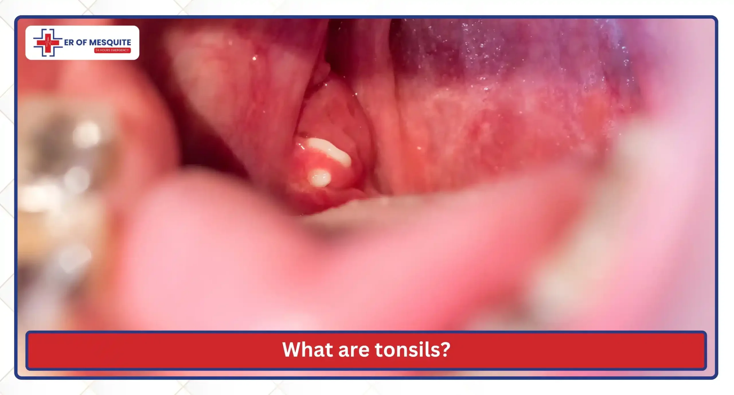 What are tonsils