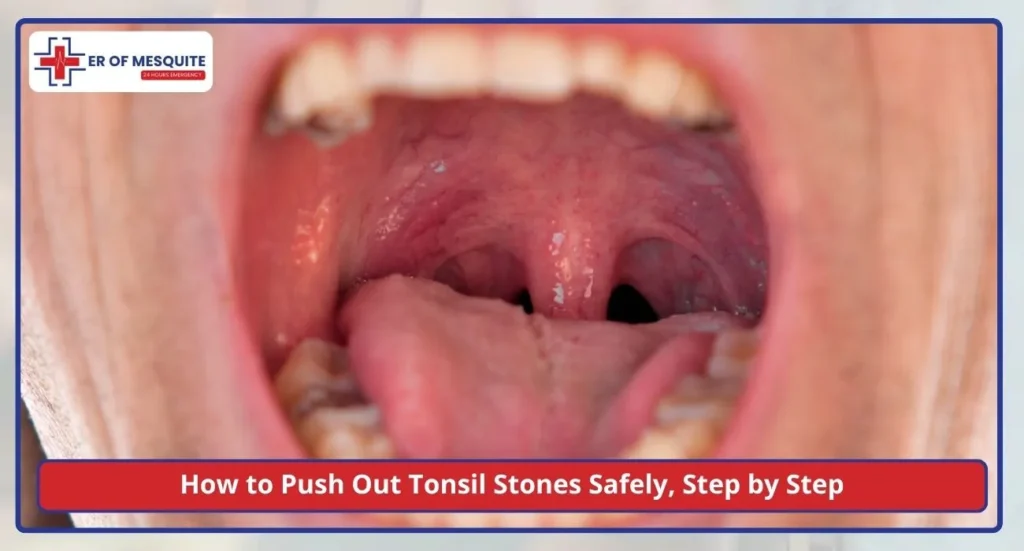 How to Push Out Tonsil Stones Safely, Step by Step
