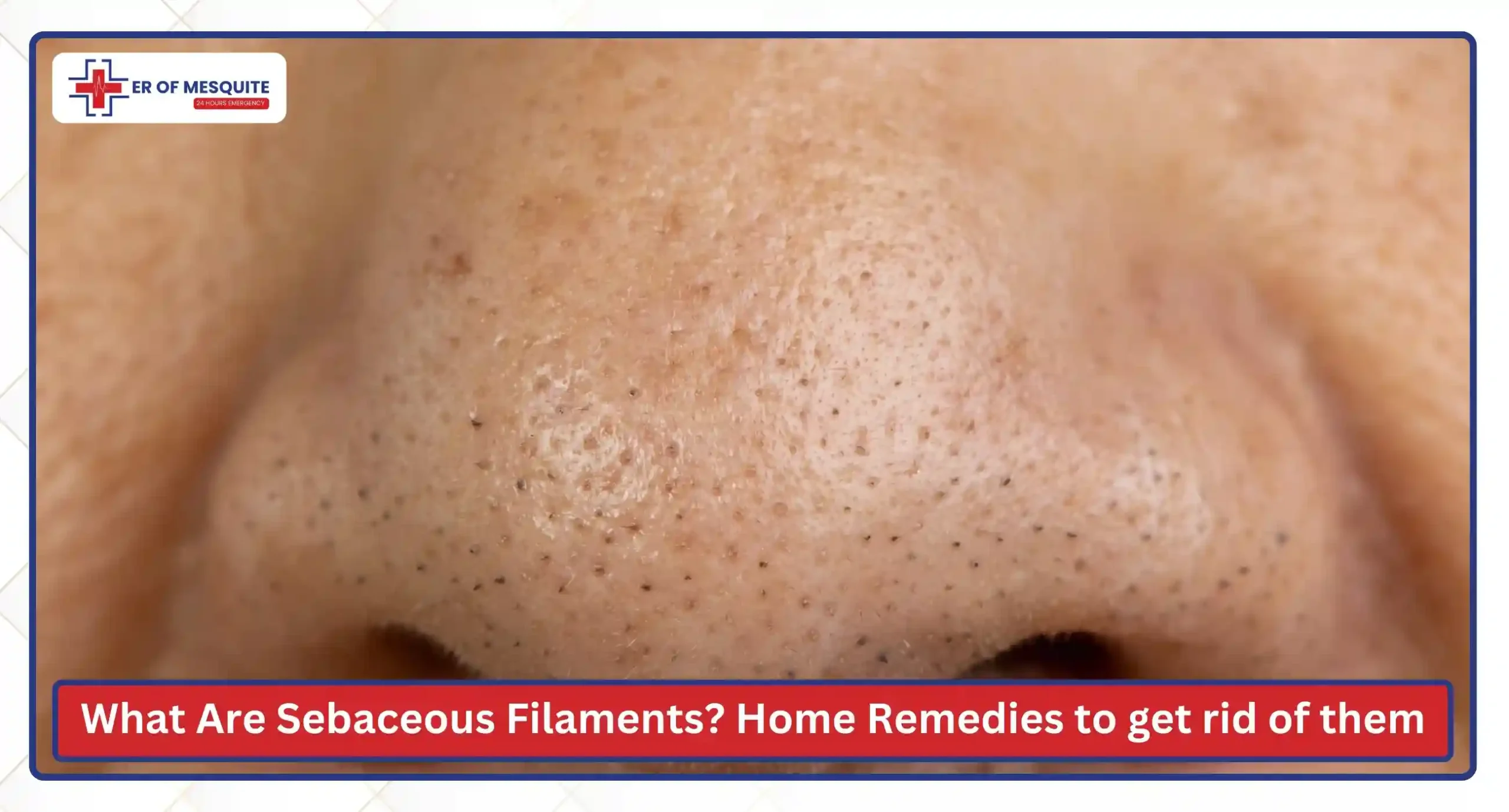 What Are Sebaceous Filaments