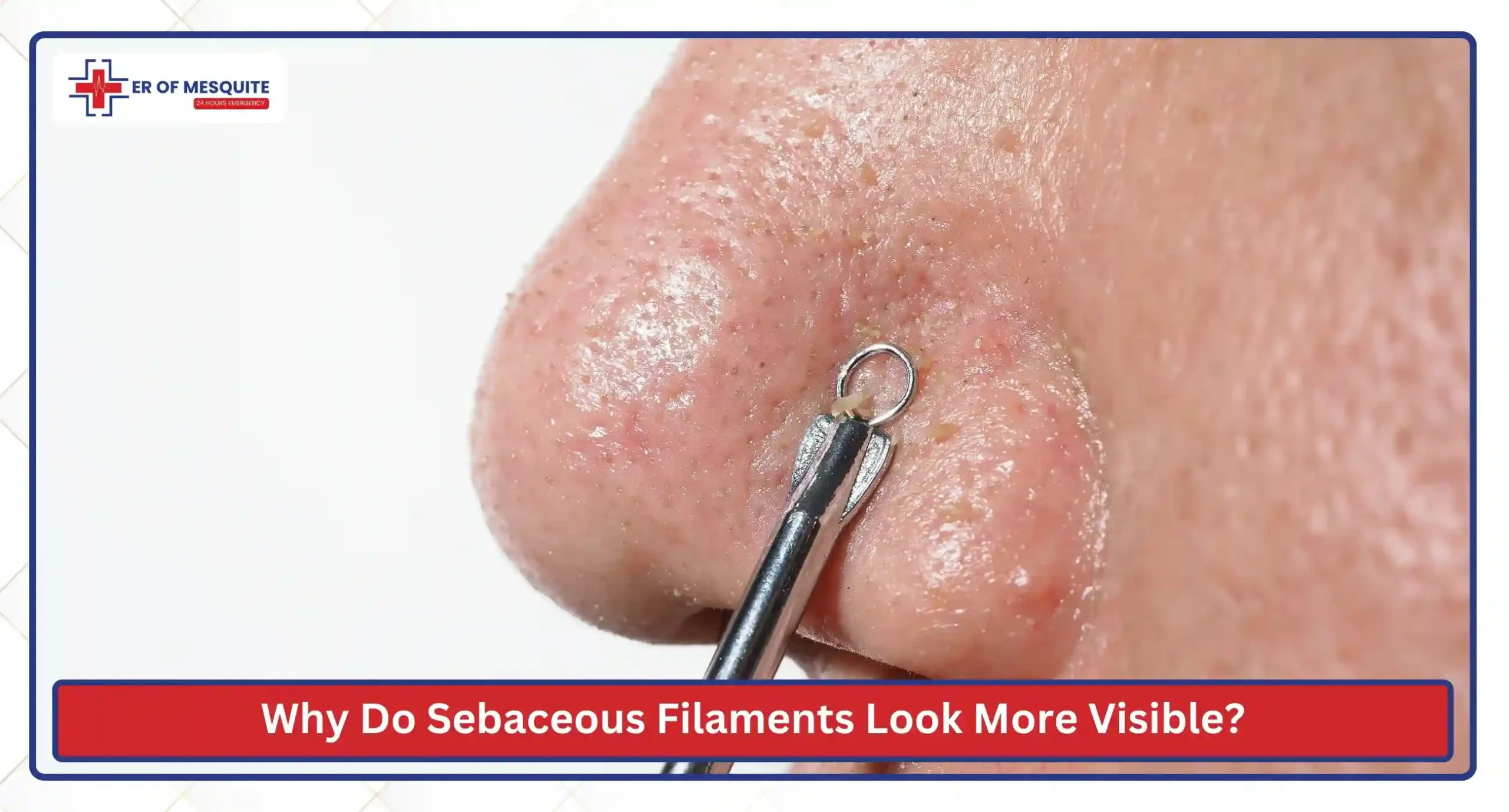 Why Do Sebaceous Filaments Look More Visible