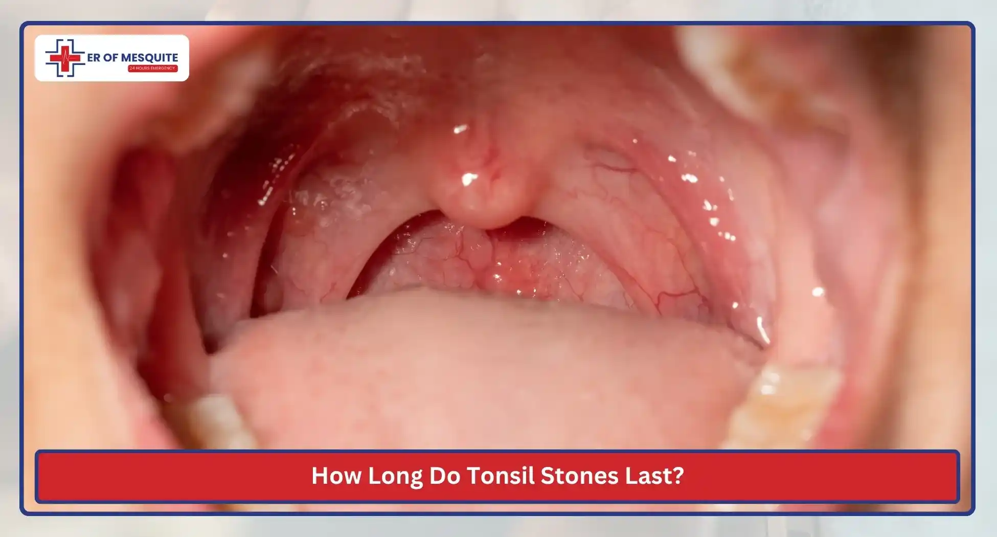 How Long Do Tonsil Stones Last