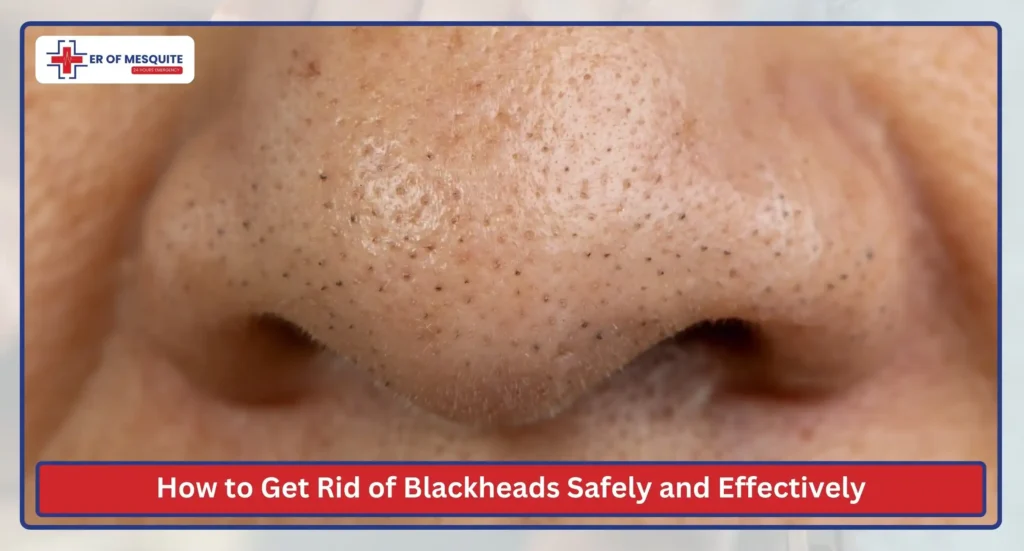How to Get Rid of Blackheads Safely and Effectively