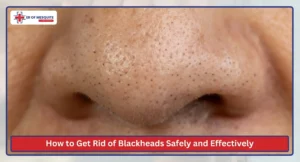 How to Get Rid of Blackheads Safely and Effectively