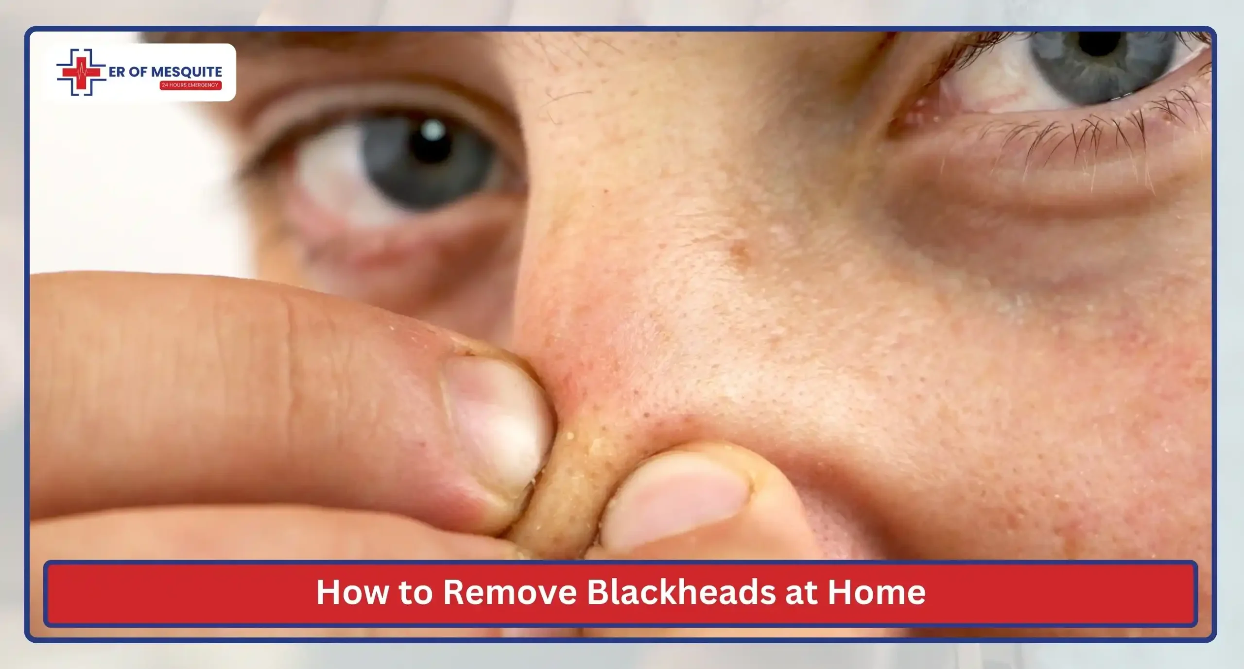 How to Remove Blackheads at Home