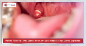 How to Remove Tonsil Stones You Can’t See Hidden Tonsil Stones Explained