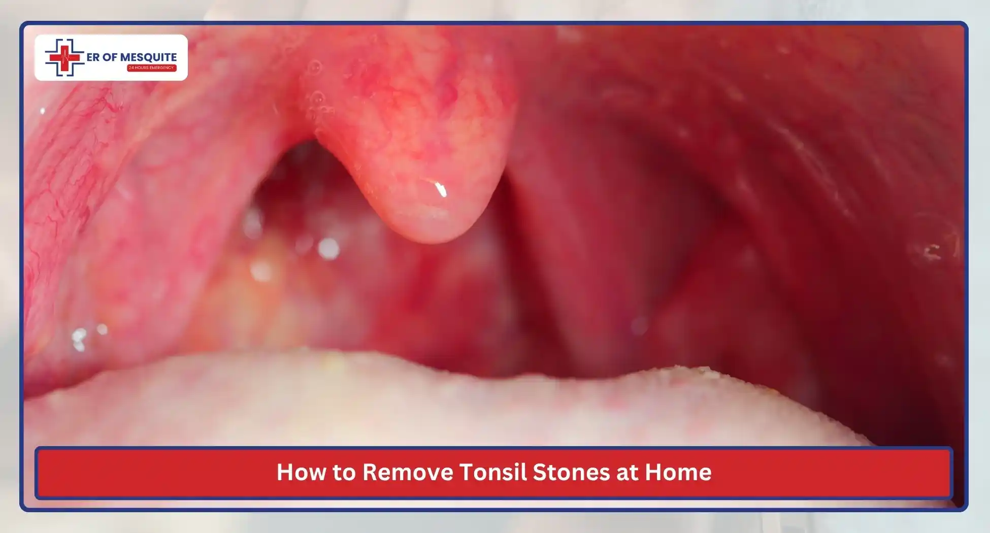 How to Remove Tonsil Stones at Home