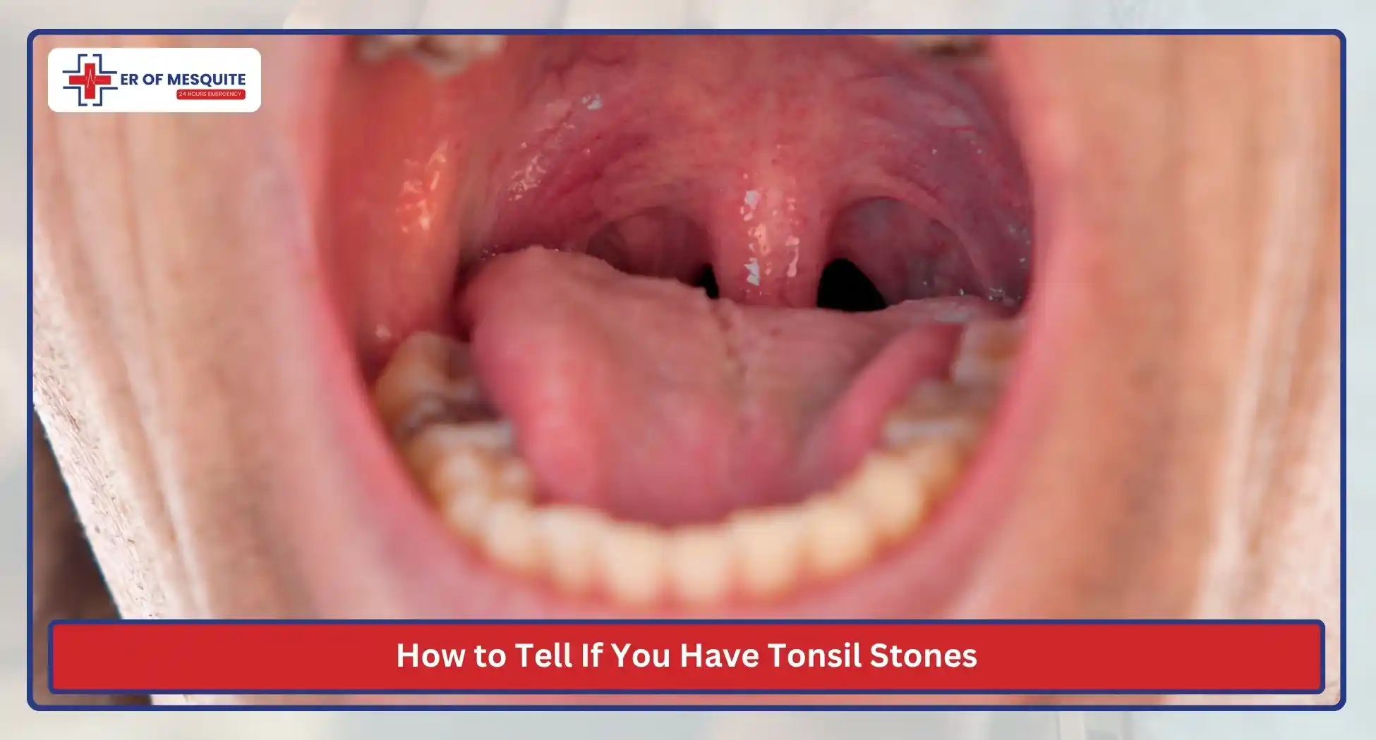 How to Tell If You Have Tonsil Stones