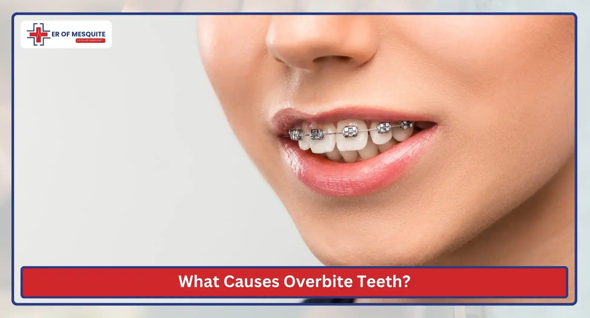 What Causes Overbite Teeth