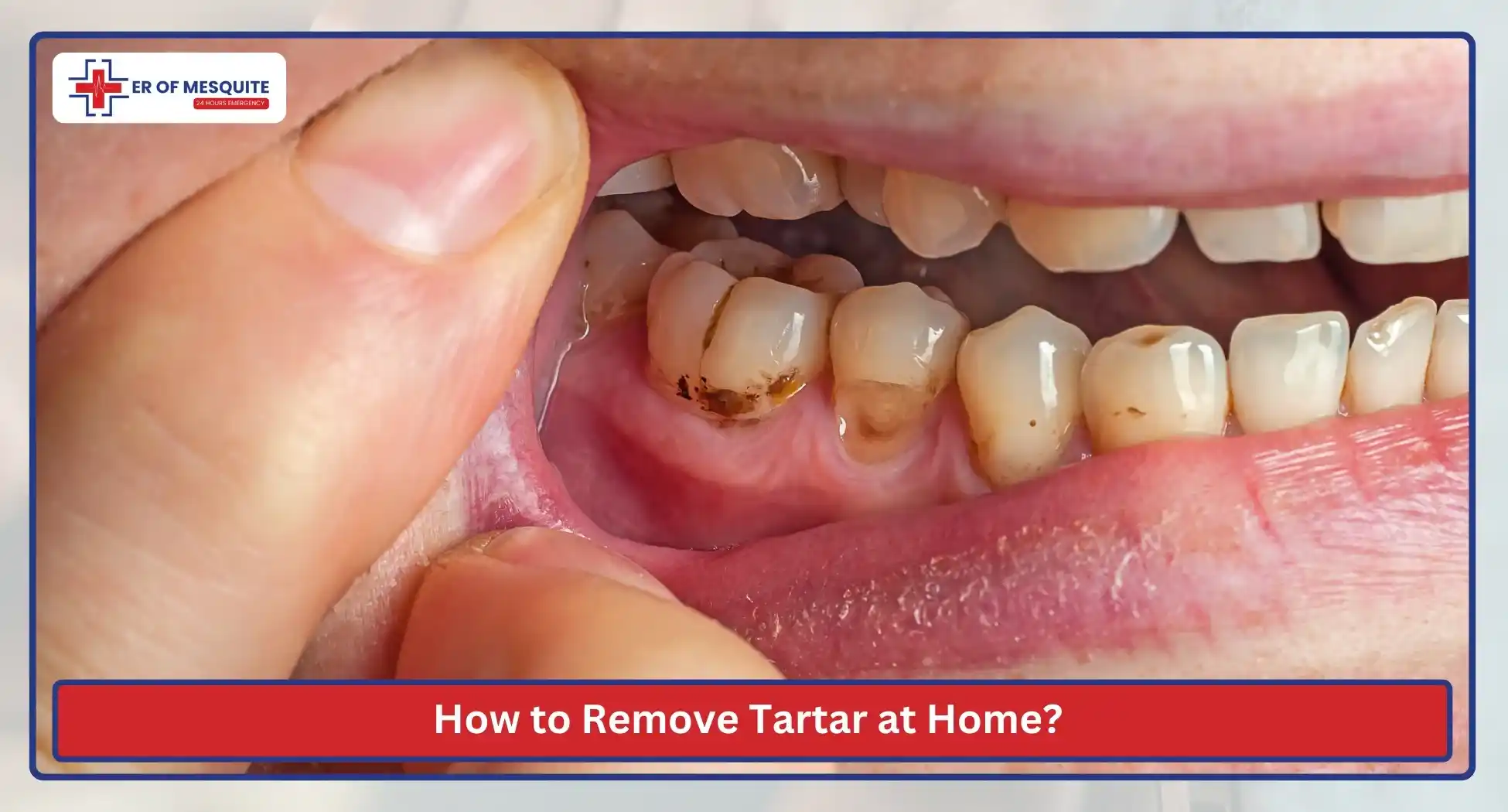 How to Remove Tartar at Home