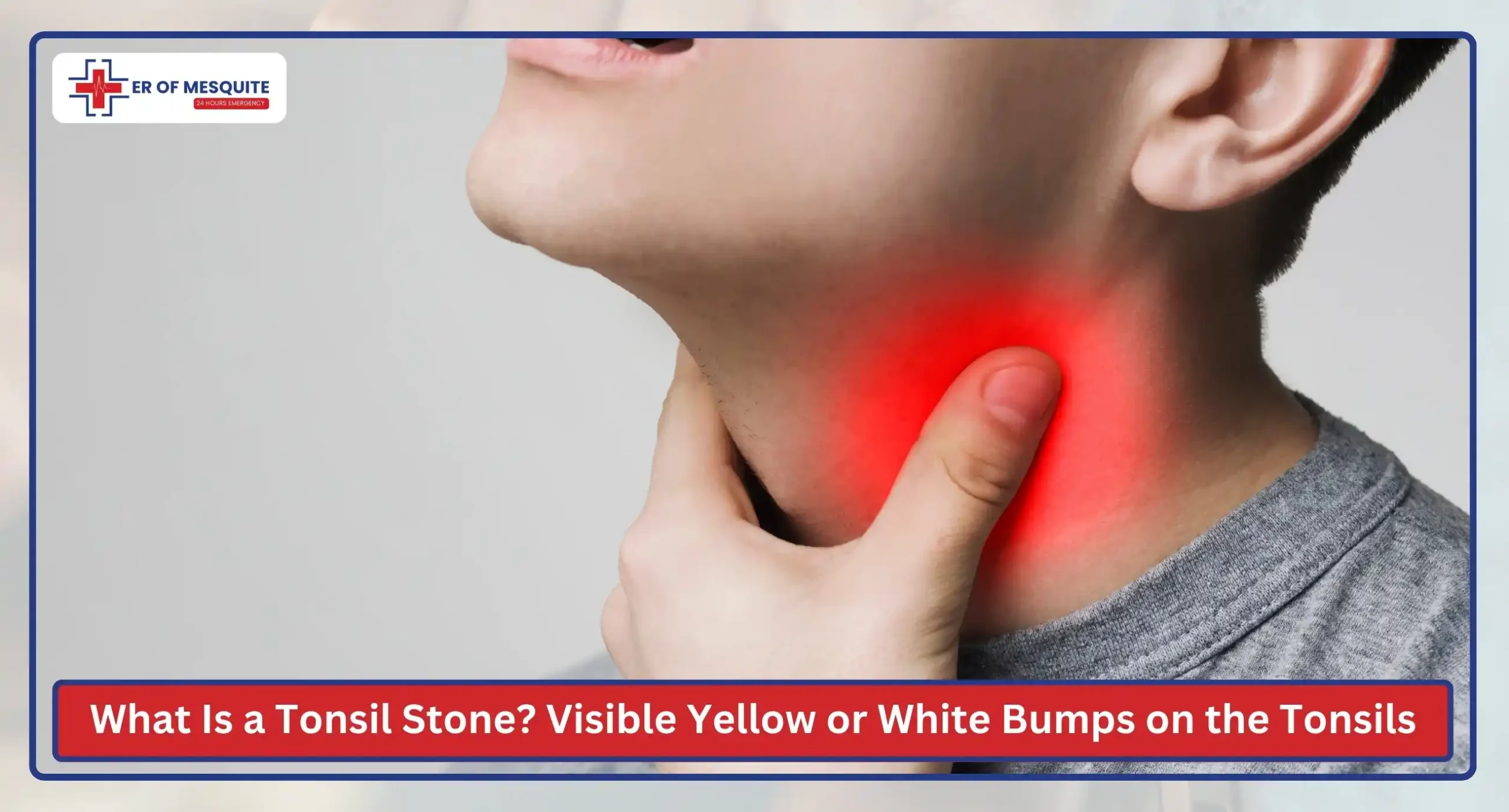 What Is a Tonsil Stone
