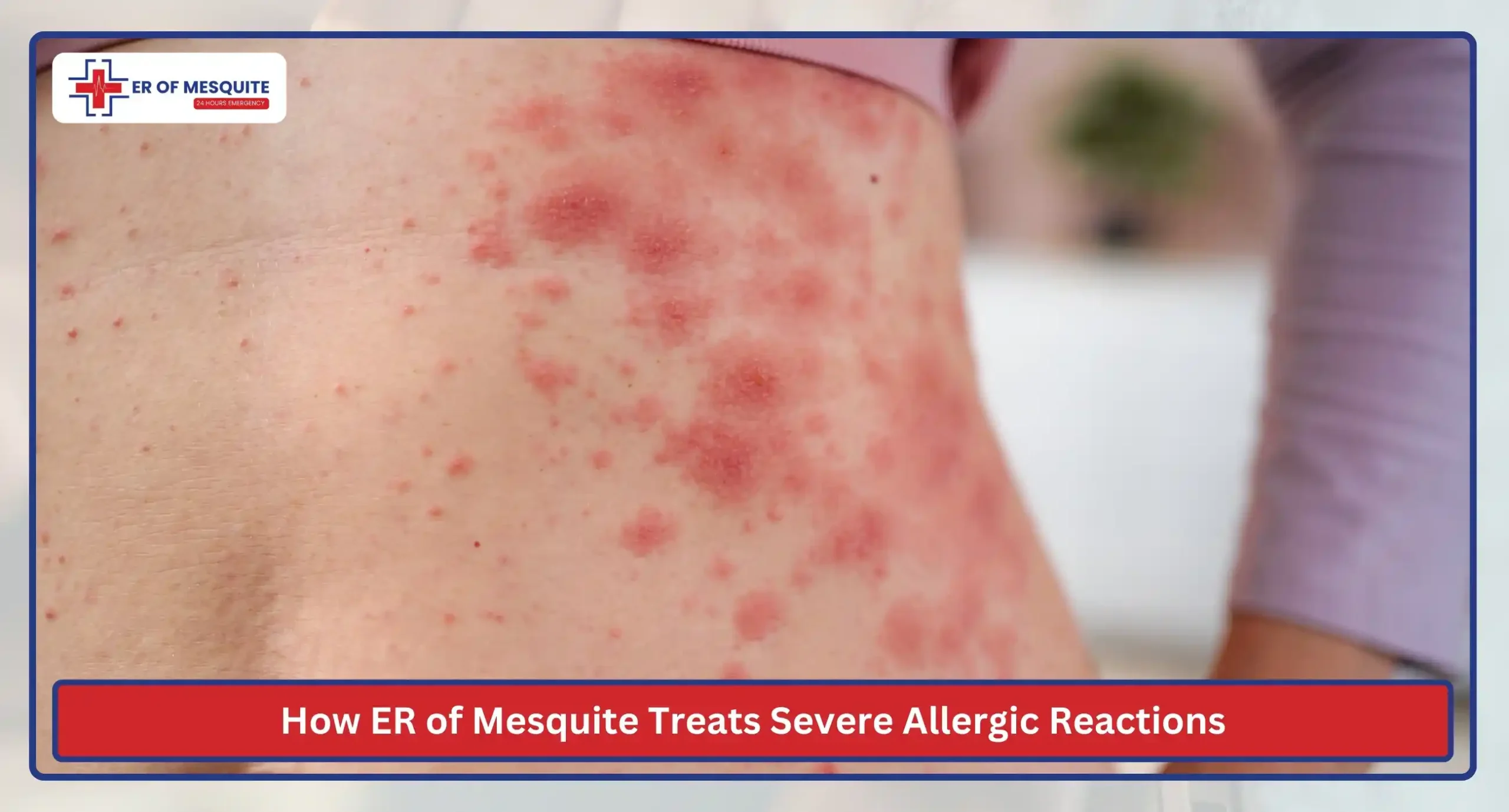 How ER of Mesquite Treats Severe Allergic Reactions
